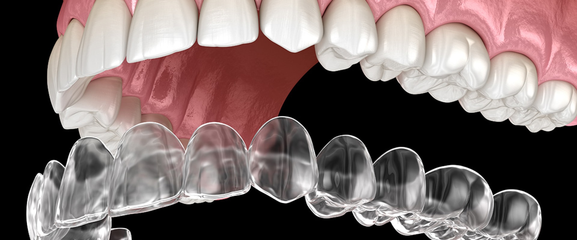 Why Clear Aligners are So Expensive: An Expert's Perspective