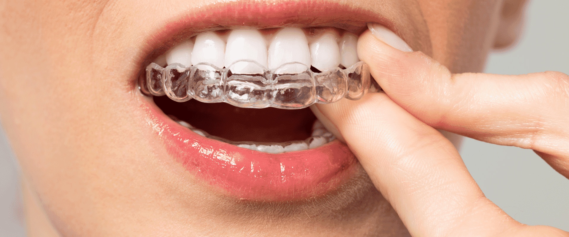 Are clear aligners fda approved?