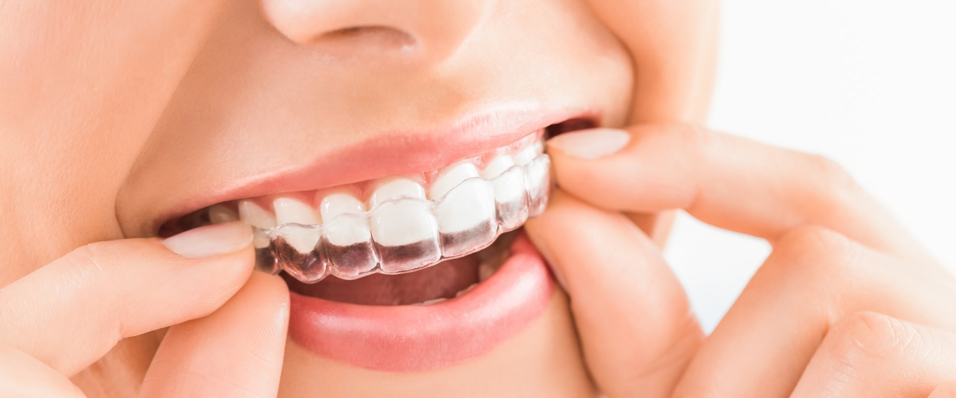 Everything You Need to Know About Clear Aligners for Teeth