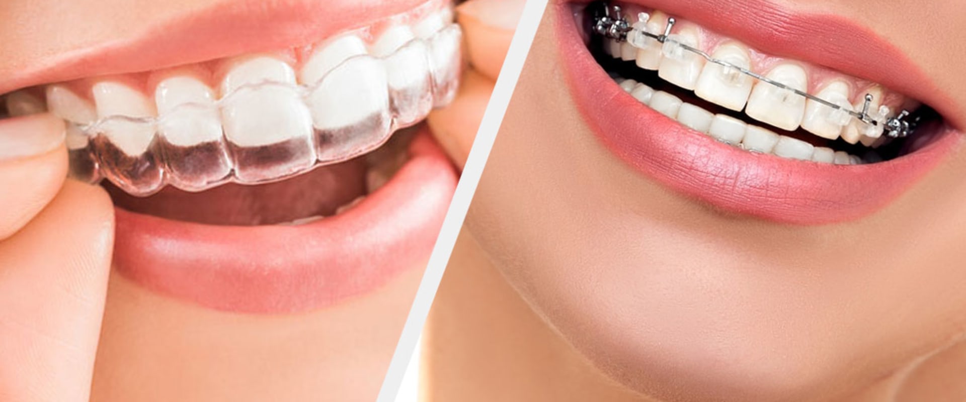 The Benefits of Clear Aligners: Why You Should Consider Them