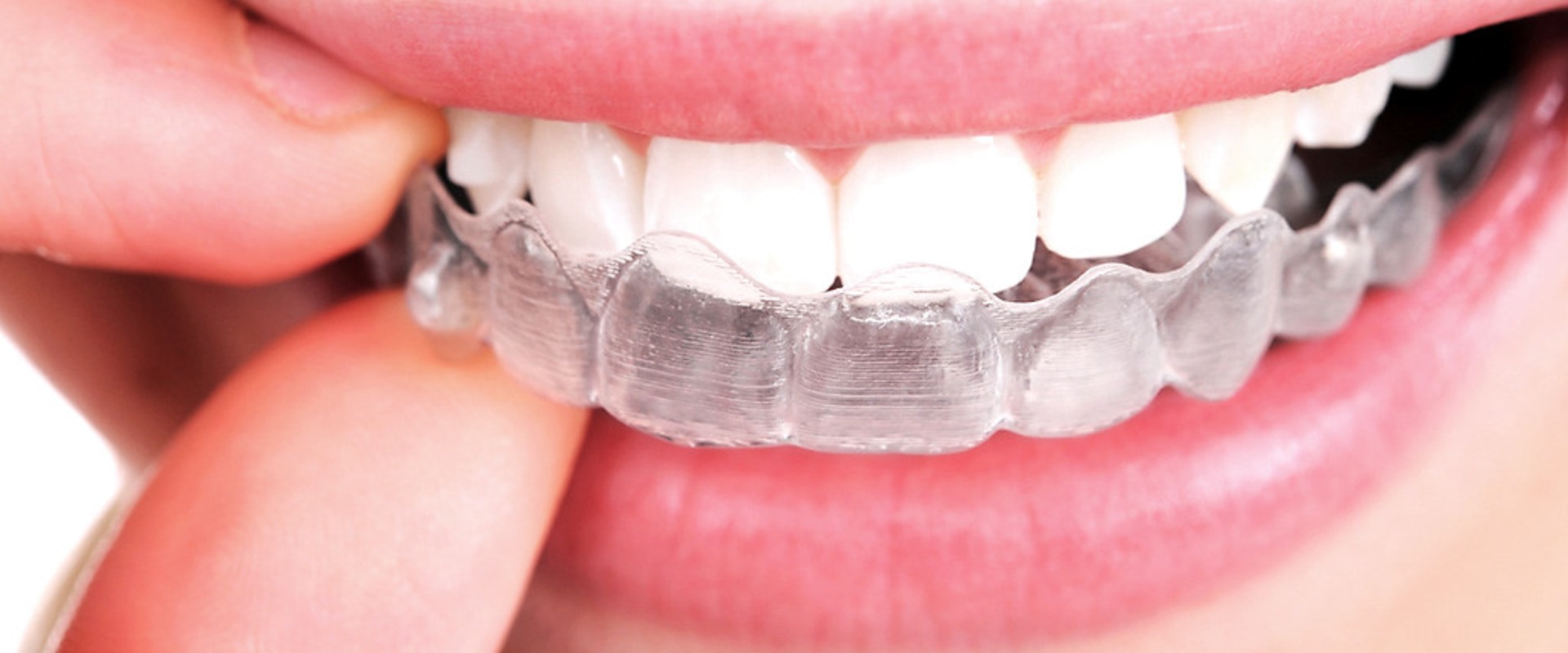 Do Clear Aligners Work as Well as Braces?