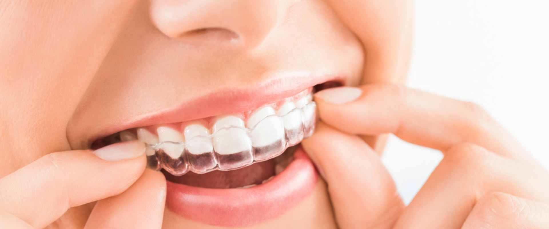 How Long Does Treatment with Clear Aligners Take?