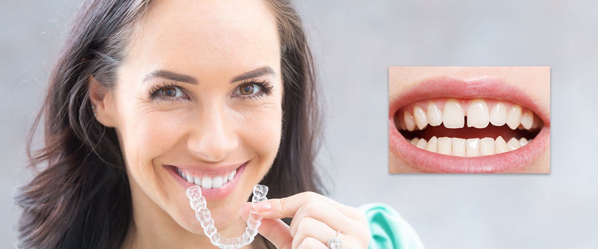Can Clear Aligners Close Gaps? A Comprehensive Guide