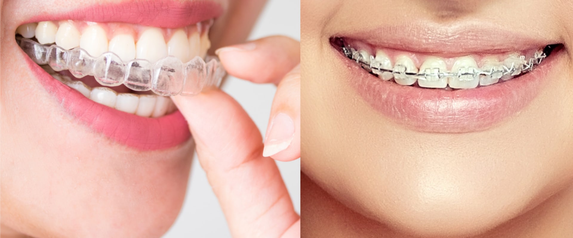 Are Clear Aligners Really the Same?
