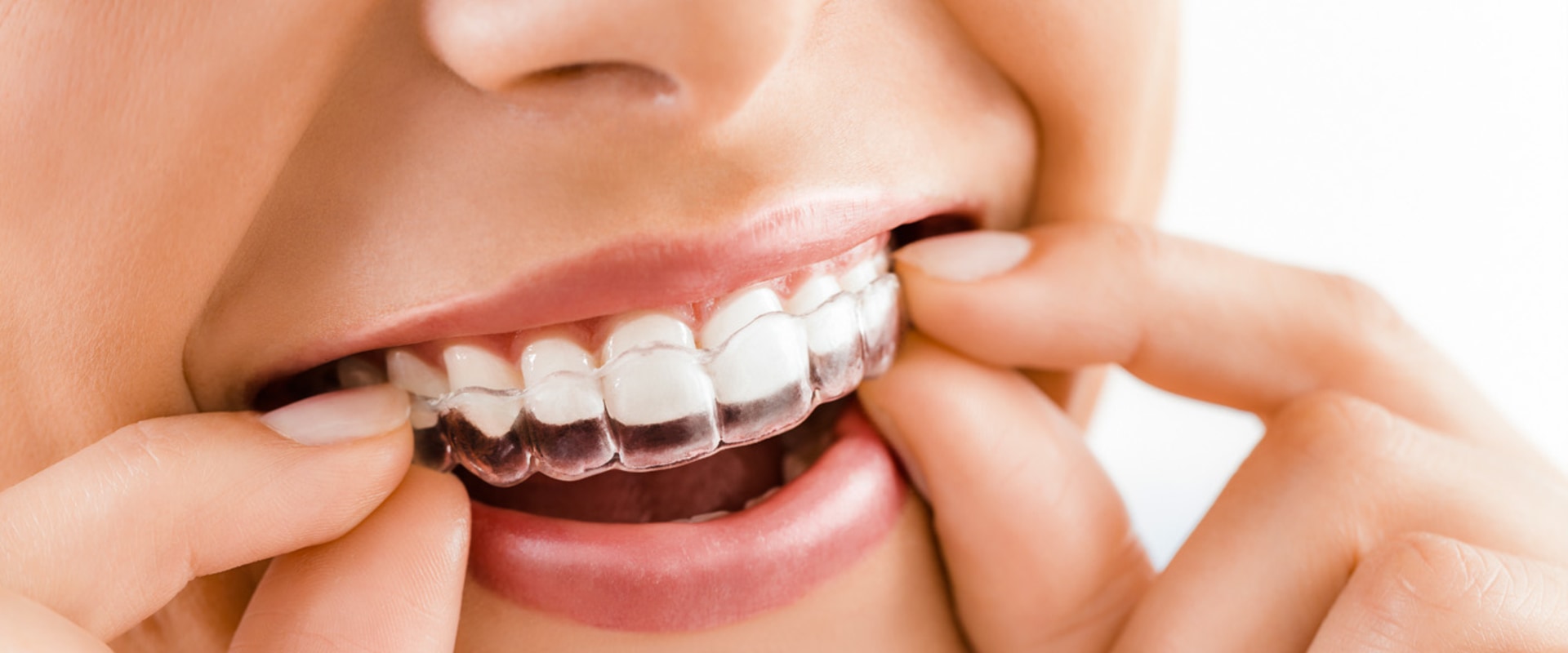 What is the fastest invisalign treatment?