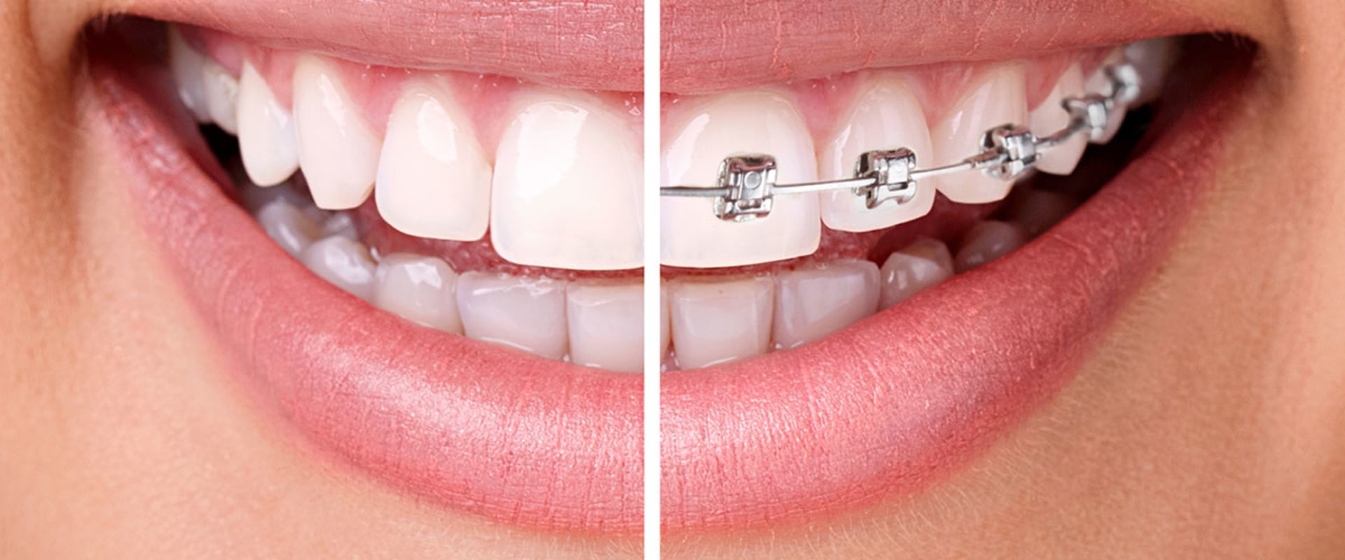 How Long Does Invisalign Take to Straighten Teeth?