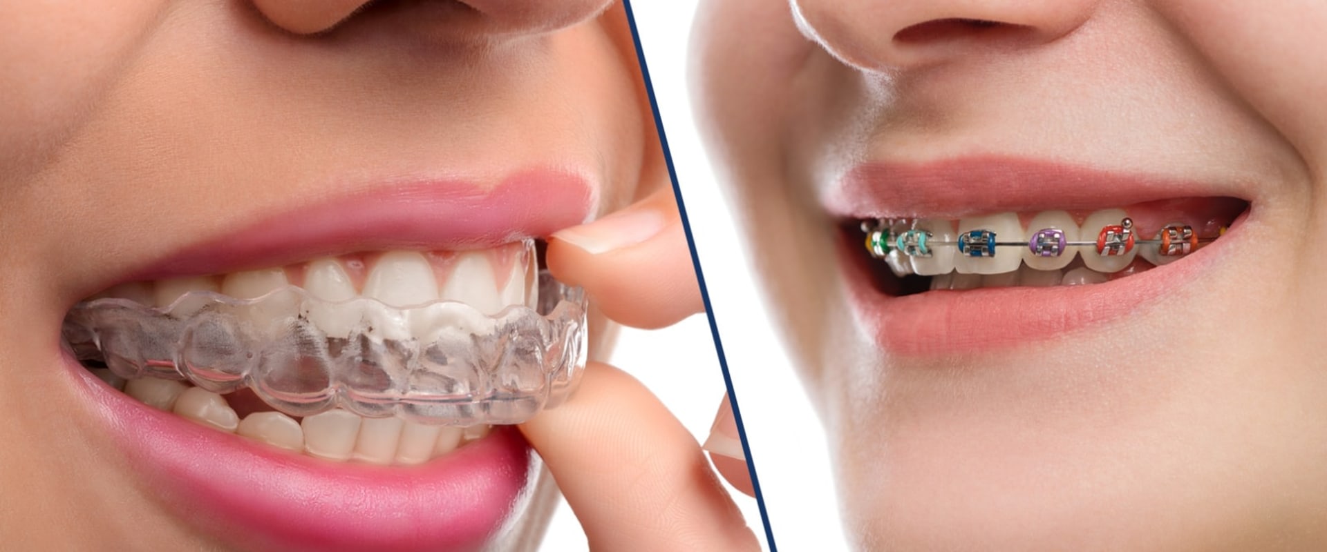 The Benefits of Clear Aligners Over Braces