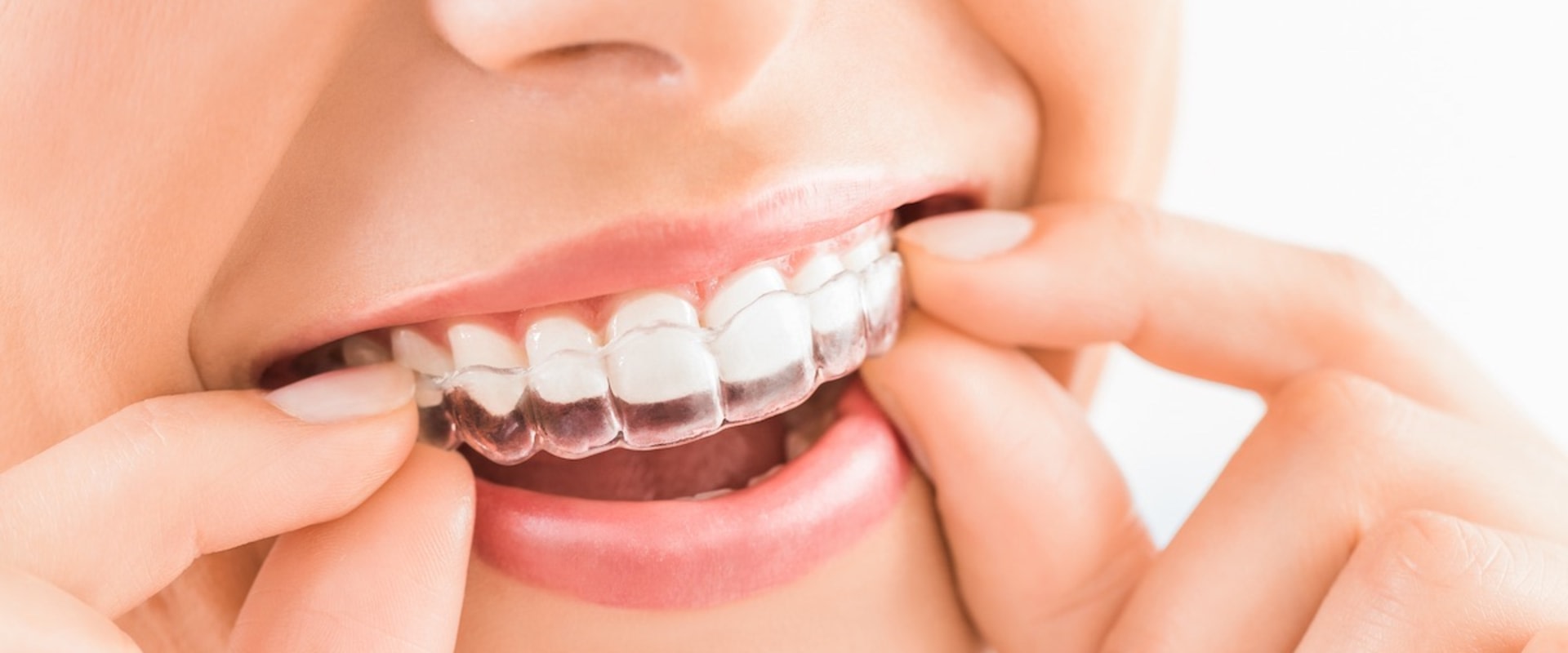 How Much Does Clear Aligners UK Cost?