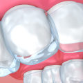 Can Clear Aligners Correct Crowded Teeth?