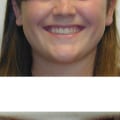 Can clear aligners fix an open bite?