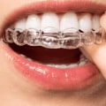 Are clear aligners fda approved?