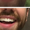 Clear Aligners UK: A Comprehensive Review