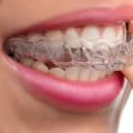 Are Clear Aligners Worth It?