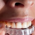 Which Clear Aligners are the Cheapest?