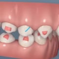 Do Clear Aligners Work Faster Than Braces?