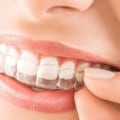 Do Clear Aligners Damage Teeth?
