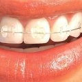 Are Clear Aligners Visible? An Expert's Perspective