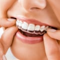 What is the fastest invisalign treatment?