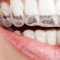 Can Clear Aligners Fix Spacing Issues?