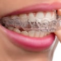 How Much Does it Cost to Get Aligners for Your Teeth?