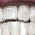 How to Tell if Clear Aligners are Working