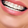 Which Clear Aligners are the Best for You?