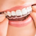 Which Clear Aligners are the Best in the UK?