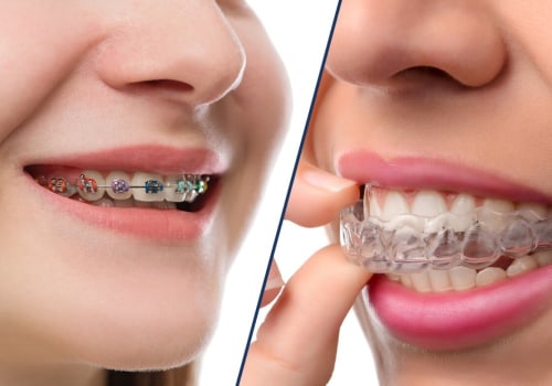 Comparing Clear Aligners and Invisalign: What's the Difference?