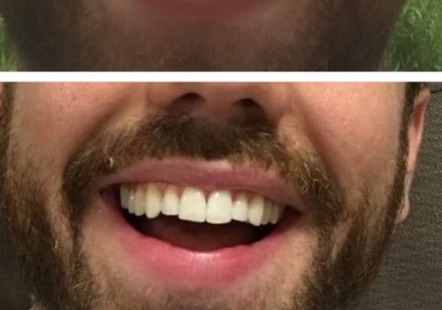 Clear Aligners UK: A Comprehensive Review