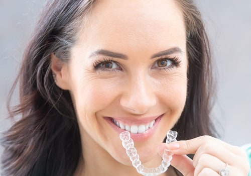 Can Clear Aligners Fix Gaps? A Comprehensive Guide