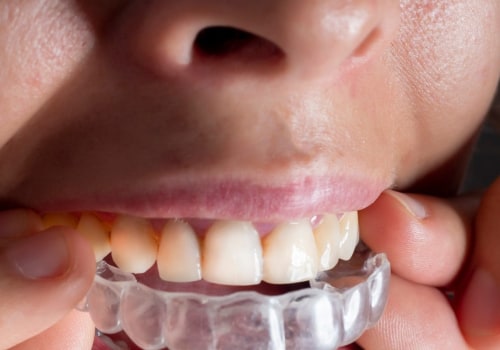 Which Clear Aligners are the Cheapest?