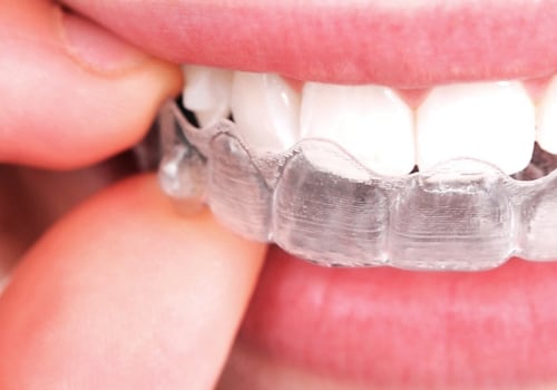 Do Clear Aligners Work as Well as Braces?