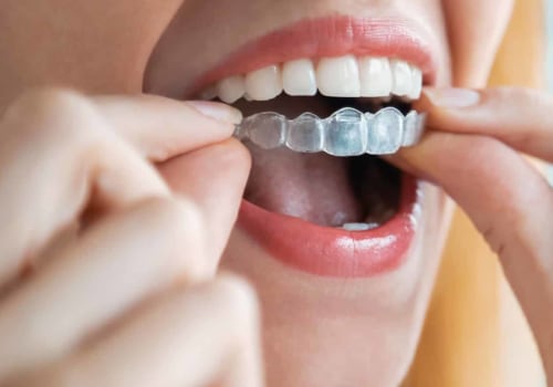 What are Spark Clear Aligners and How Can They Help You?