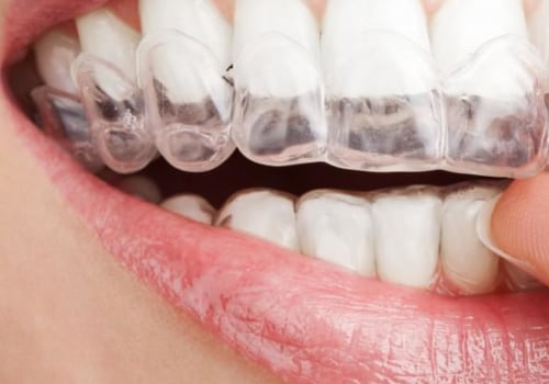 Can Clear Aligners Damage Gums?