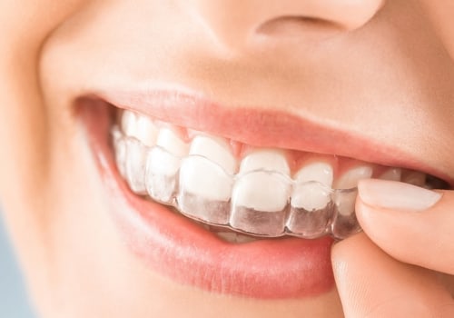 Do Clear Aligners Damage Teeth?