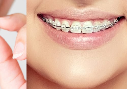 Are Clear Aligners Really the Same?
