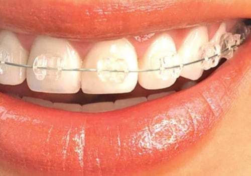 Are Clear Aligners Visible? An Expert's Perspective