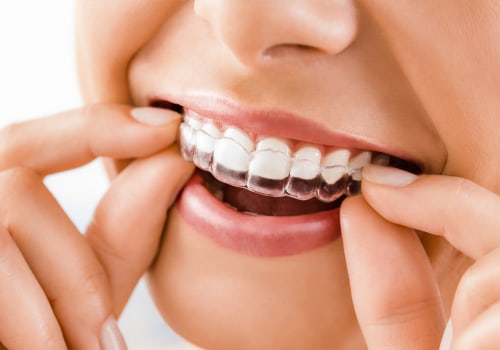 What is the fastest invisalign treatment?