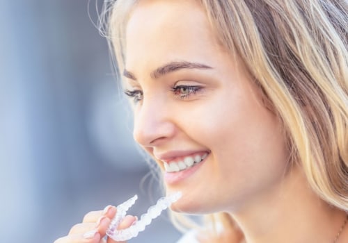 Are Spark Aligners Faster Than Braces or Other Clear Aligners?