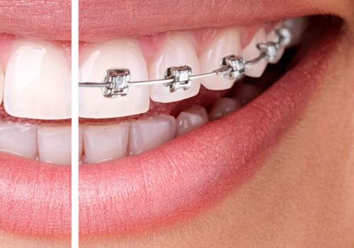How Long Does Invisalign Take to Straighten Teeth?