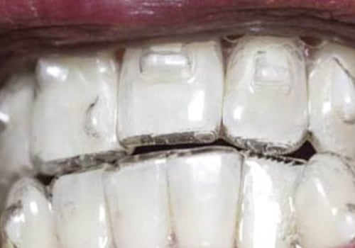 How to Tell if Clear Aligners are Working
