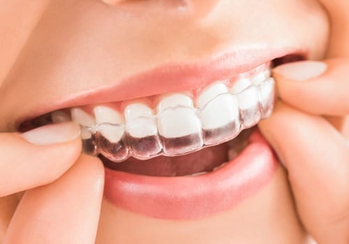 Do Clear Aligners Work Faster Than Braces?